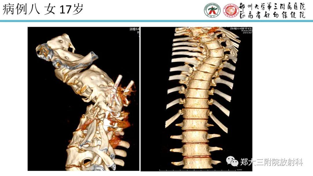 神经纤维瘤病最新资讯速递